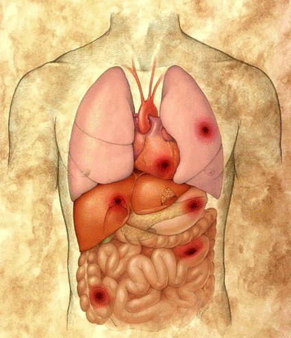 Image: Locations of sepsis or infection, indicated by dark spots (Photo courtesy of Brian Evans / SPL).